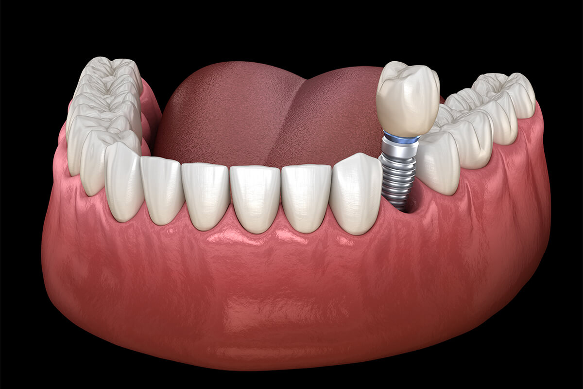 Image of the procedure how dental implants placed in mouth